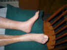 Gout after Reflexology with Suzanne
